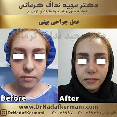 جراحی زیبایی بینی دکتر نداف کرمانی